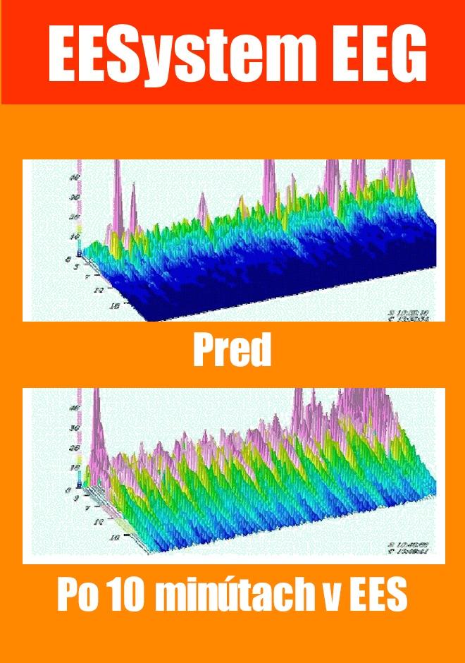 EEsystem EEG - výsledok
